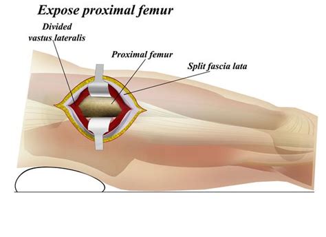 Femur Lateral Approach Approaches Orthobullets