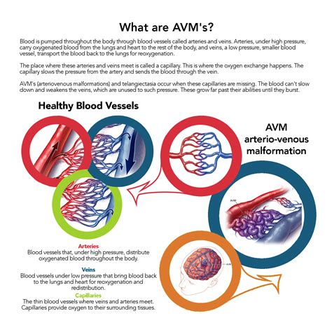 Brain Avm Arteriovenous Malformation Symptoms And