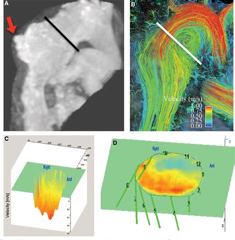 Figure 1 From Four Dimensional Flow Magnetic Resonance Imaging With