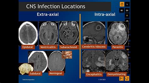 Cns Infections Radiologic Pathologic Correlation Youtube