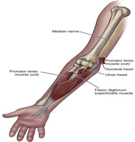 Proximal Entrapment Of The Median Nerve By The Pronator Teres Muscle
