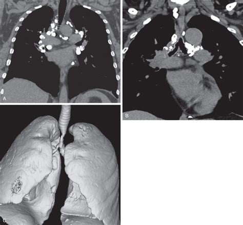 Pulmonary Metastases Radiology Key