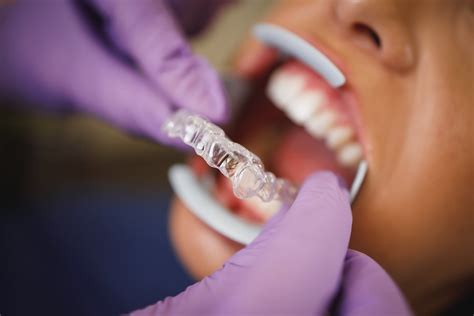 Invisalign Vs Traditional Braces Differences Between Them