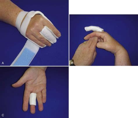 Joint Replacement In The Hand And Wrist Surgery And Therapy