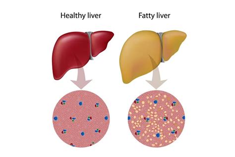 Fasting And Liver A Miracle Health Care Dr Faisal Dar