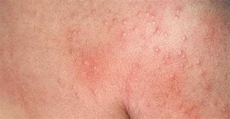 Healthooldengue Fever Rash Pictures Atlas Of Rashes Associated With