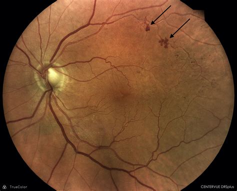 A Peculiar Retinal Scan In A Patient With Diabetes Consultant360