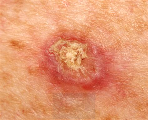 Skin Cancer And Precancerous Skin Lesions What You Need To Know Skin