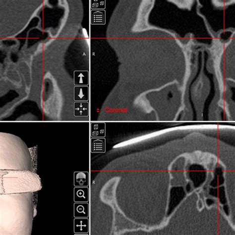 Pdf The International Frontal Sinus Anatomy Classification Ifac And