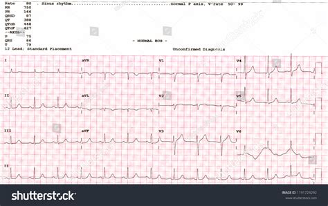 Cardiogram Waveform Ekg Showing Normal Ekg Stock Photo 1191723292