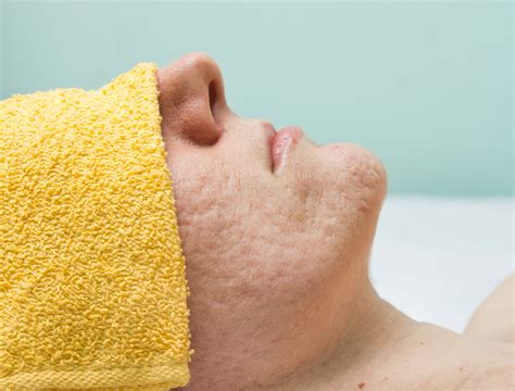 your guide to laser treatments for acne scars prime women an online magazine