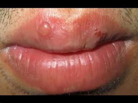 If treated as soon as your sores appear, your doctor may prescribe a type of medicine called an antiviral. How Long Do Cold Sores Last | Why Do People Get Cold Sores ...