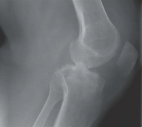 Septic Arthritis Knee Radiology Key