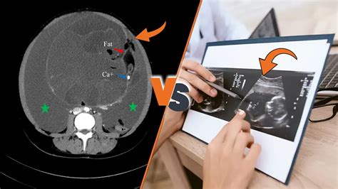 Ovarian Cyst Diagnosis Ct Scan Vs Ultrasound Youtube