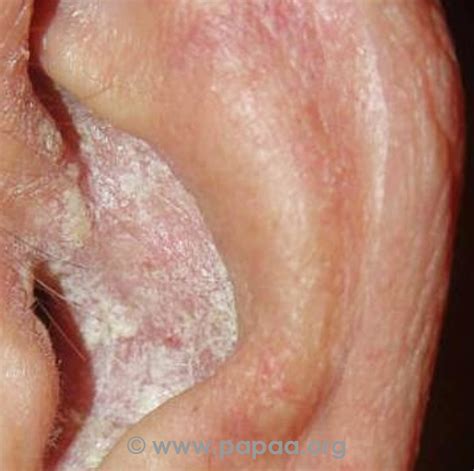 Plaque Psoriasis Ear