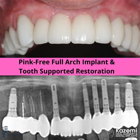 Full Arch Dental Implant And Tooth Supported Teeth For A Natural