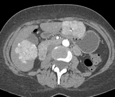 Multiple Focal Nodular Hyperplasia In The Liver Fnh Liver Case