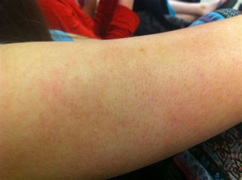 My Friends Arm Is Red And Blotchy Bumps Too Help Beautylish
