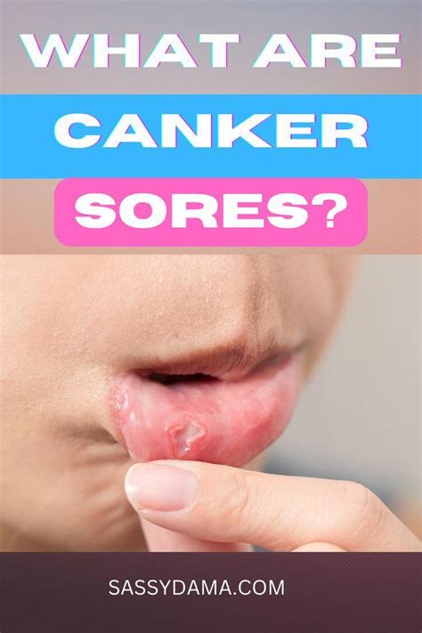 Canker Sores Are Small Shallow And Painful Ulcers Or Lesions That