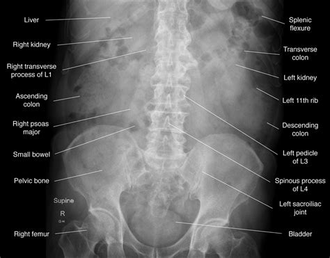 Pelvic X Ray Anatomy