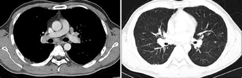 Chest Ct Shows Bilateral Mediastinal And Hilar Lymphadenopathy And