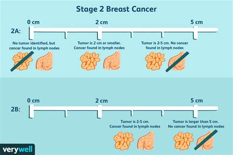 Stage 2 Breast Cancer Diagnosis Treatment Survival