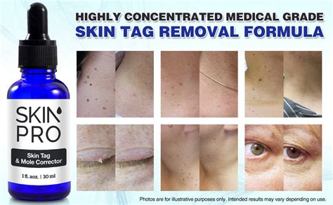 Skinpro Skin Tag Remover And Mole Corrector Medical Grade