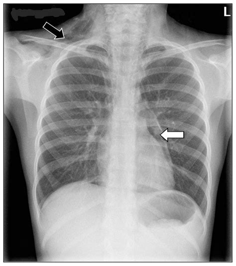 Pneumomediastinum And Subcutaneous Emphysema Associated With Pandemic