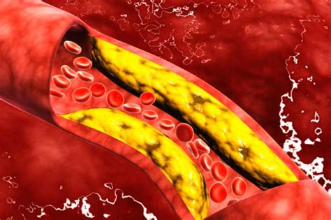 Clean Your Blood Vessels And Clogged Arteries Naturally Home Remedies
