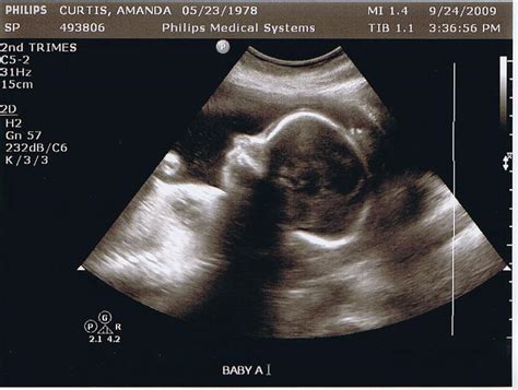 Sonagramssonogram 24 Weeks Baby A2