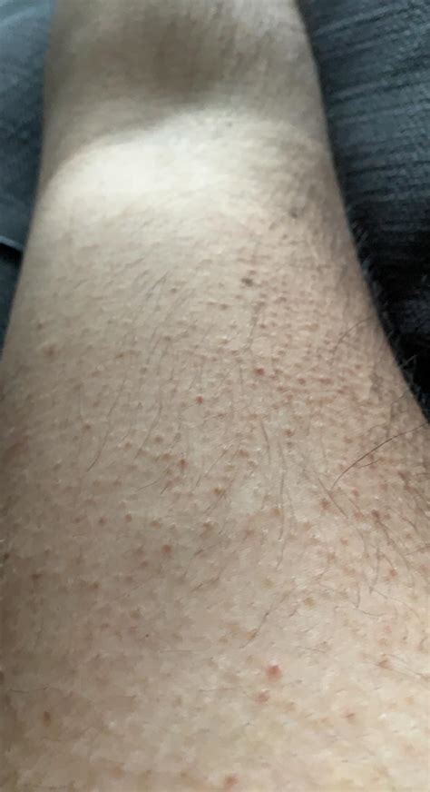 What Are These Raised Bumps On My Arms Rdermatologyquestions