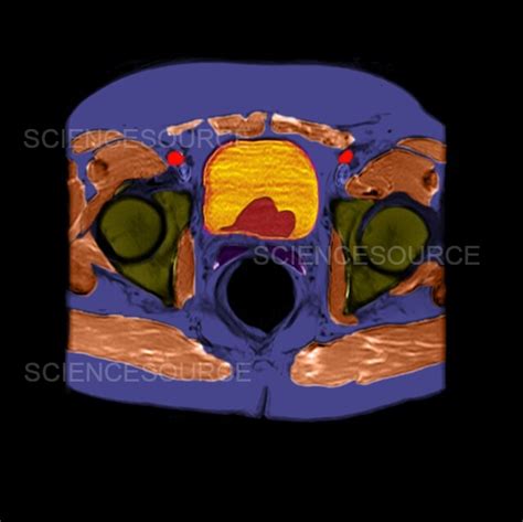 Photograph Ct Cross Section Of Enlarged Prostate Science Source Images