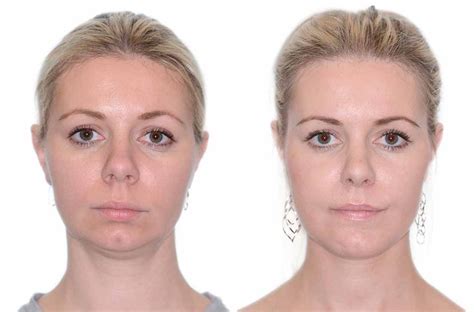 Pin By Ada On Jawline And Mewing Jaw Surgery Orthognathic Surgery