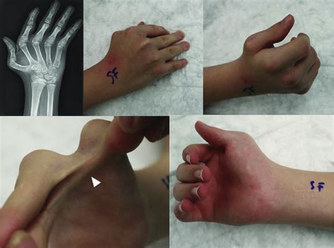 A Patient With Da And Wbhs Note The Ulnar Finger Deviation In The