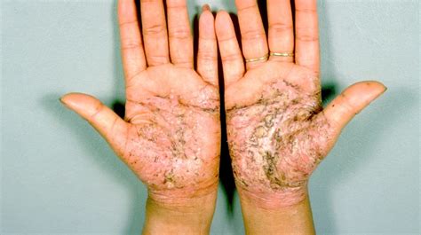 Pustular Psoriasis Diagnosis Types Treatment And More