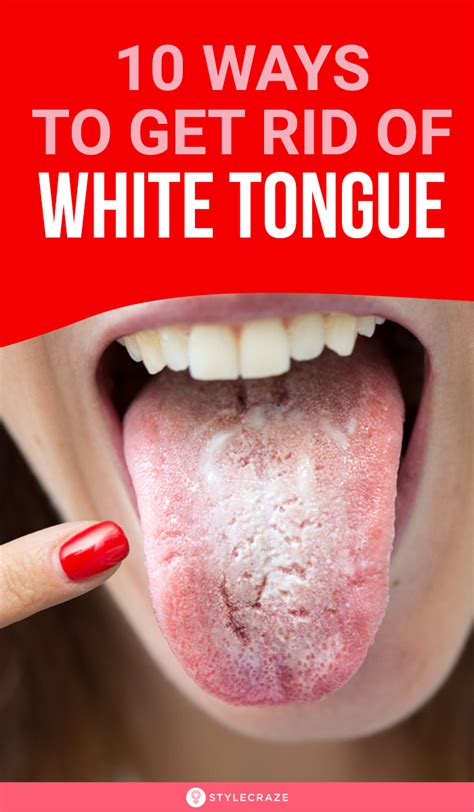 10 Ways To Get Rid Of White Tongue And Make It Healthier In 2021