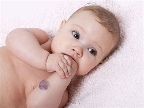 4 Things You Should Know About Hemangioma Aka Strawberry Birth Marks