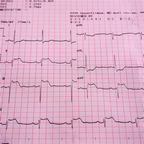 Heart Tests Singapore Diagnostic Dr Macdonald Cardiologist