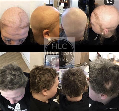 Alopecia And Treatments Hair Loss Specialist Clinic