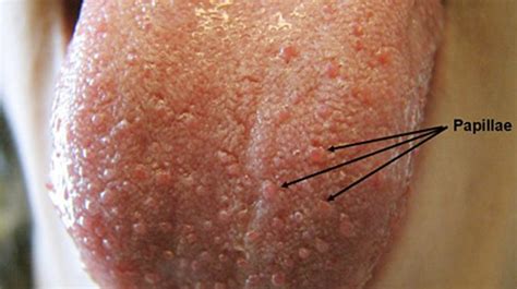 Enlarged Papillae Pictures Causes And Treatment Hubpages