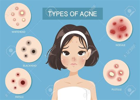 Types Of Acne Occur On The Face Of The Girl Shot Hair Ad Occur