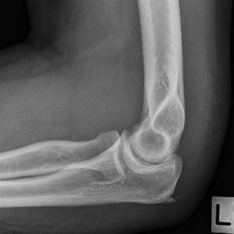 The Lateral Elbow Wikiradiography