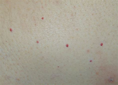 Small Red Dots Under Skin On Legs Stomach Arms