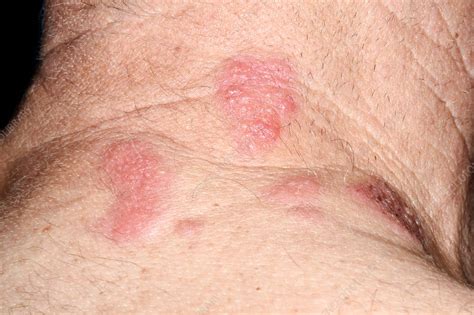 Shingles Lesions Across The Neck Stock Image C0370972 Science