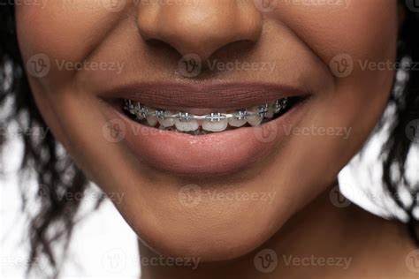 Closeup of black woman's smile with a dental braces on teeth 16291893