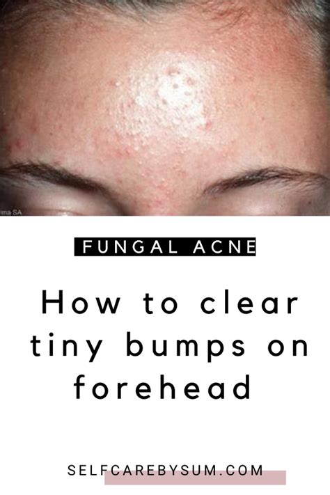 How To Clear Tiny Bumps On Forehead Self Care By Sum Forehead Bumps