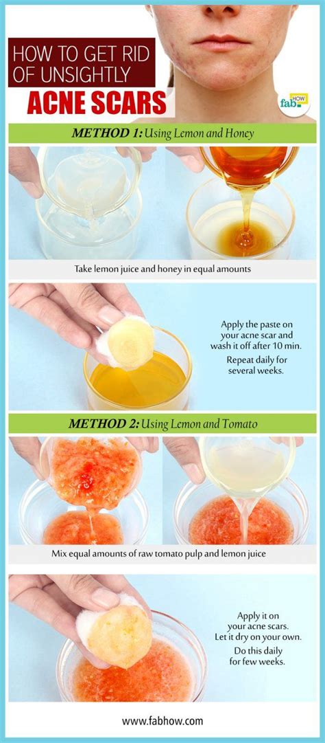 How To Get Rid Of Acne Scabs On Face Overnight At Home Get Rid Of Bumps