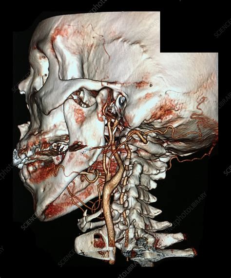 Common Carotid Artery Bifurcation 3D CTA Stock Image C039 3925