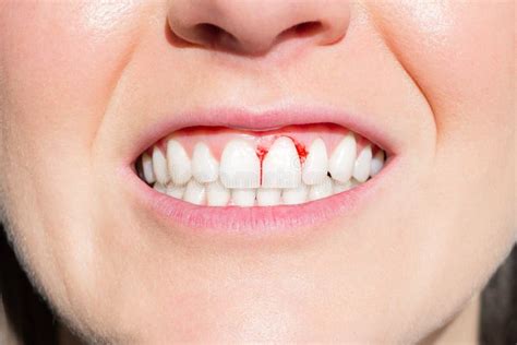 Close Up Of Woman Mouth With Bleeding Gums Stock Photo Image Of