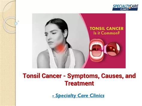 Ppt Tonsil Cancer Symptoms Causes And Treatment Powerpoint